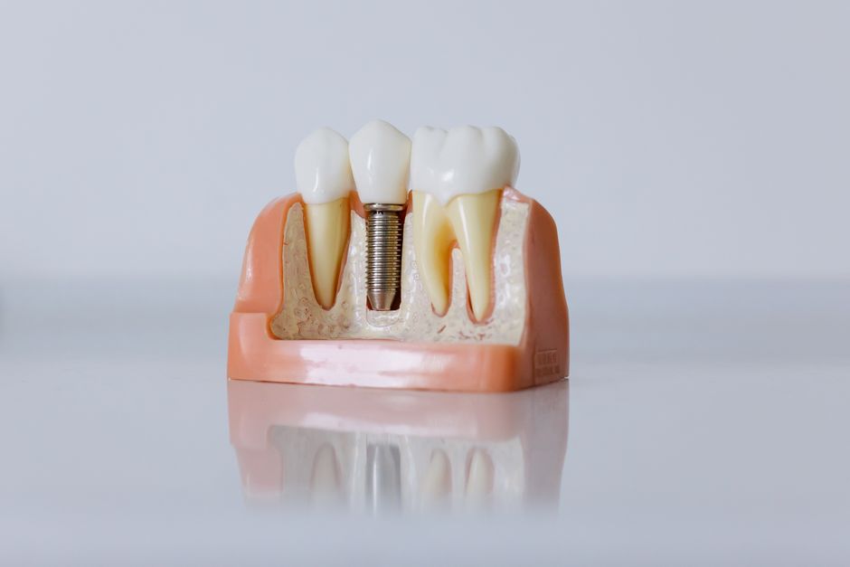 ¿Qué son los implantes dentales y cuándo son necesarios?